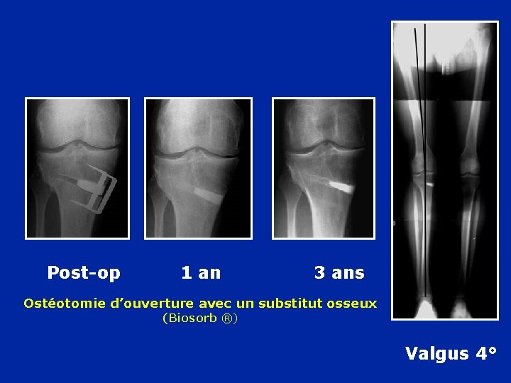 Post-op 1 an 3 ans Ostéotomie d’ouverture avec un substitut osseux (Biosorb ®) Valgus