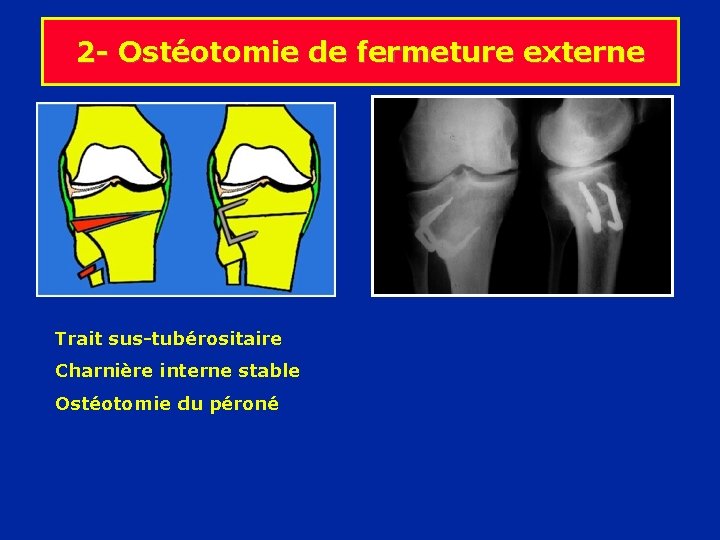 2 - Ostéotomie de fermeture externe Trait sus-tubérositaire Charnière interne stable Ostéotomie du péroné