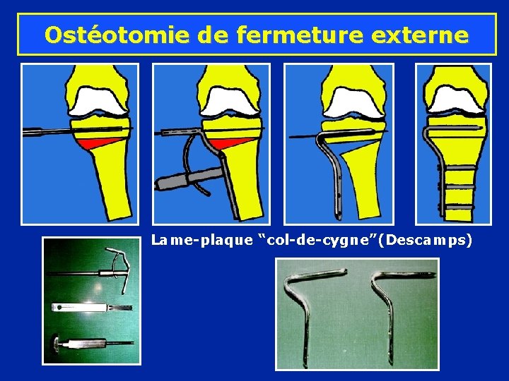 Ostéotomie de fermeture externe Lame-plaque “col-de-cygne”(Descamps) 