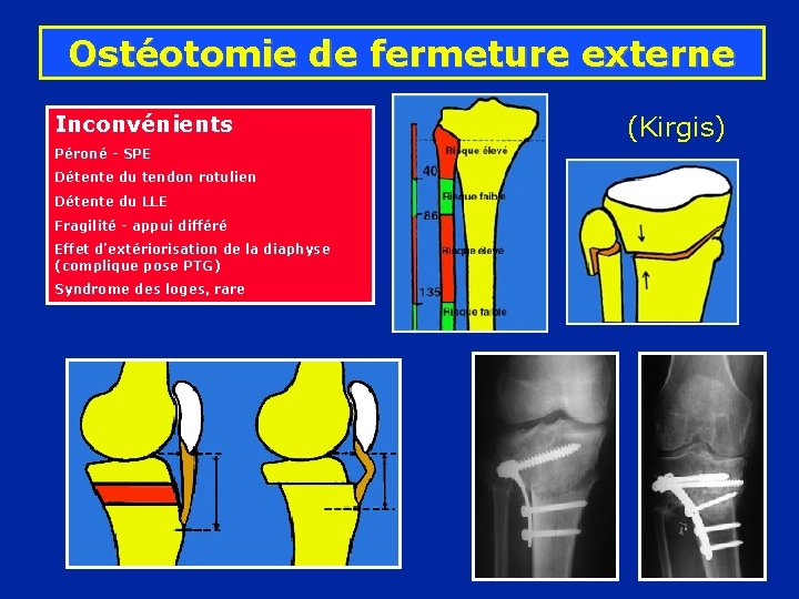 Ostéotomie de fermeture externe Inconvénients Péroné - SPE Détente du tendon rotulien Détente du