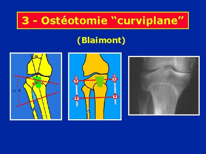 3 - Ostéotomie “curviplane” (Blaimont) 