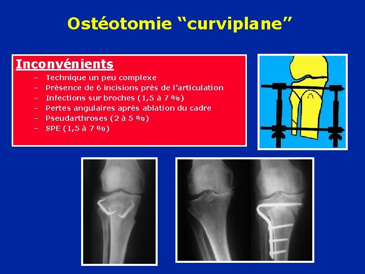 Ostéotomie “curviplane” Inconvénients – – – Technique un peu complexe Présence de 6 incisions