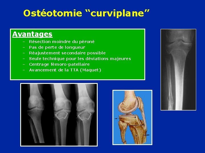 Ostéotomie “curviplane” Avantages – – – Résection moindre du péroné Pas de perte de