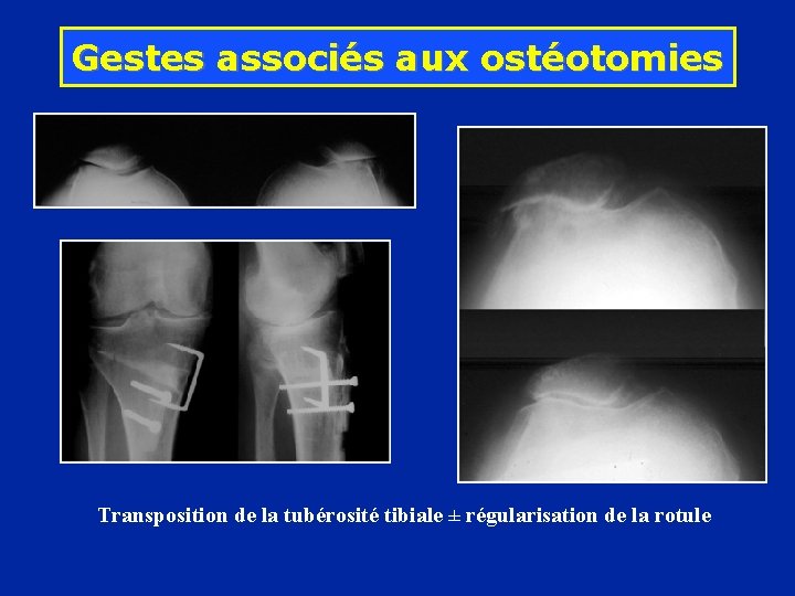 Gestes associés aux ostéotomies Transposition de la tubérosité tibiale ± régularisation de la rotule