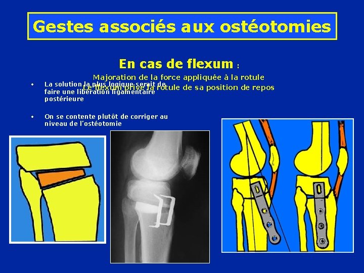 Gestes associés aux ostéotomies En cas de flexum : Majoration de la force appliquée