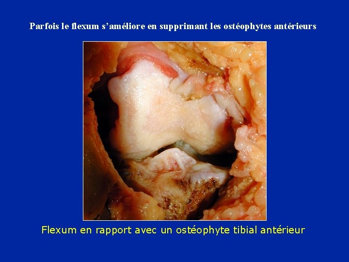 Parfois le flexum s’améliore en supprimant les ostéophytes antérieurs Flexum en rapport avec un