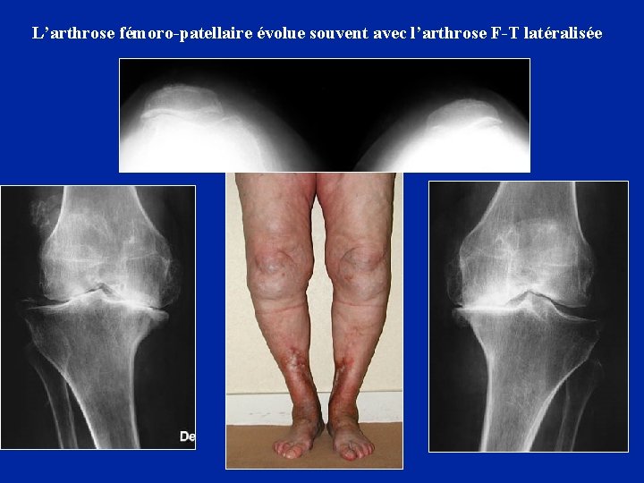 L’arthrose fémoro-patellaire évolue souvent avec l’arthrose F-T latéralisée 