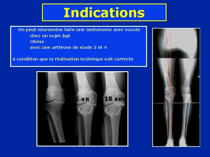 Indications On peut néanmoins faire une ostéotomie avec succès chez un sujet âgé Obèse