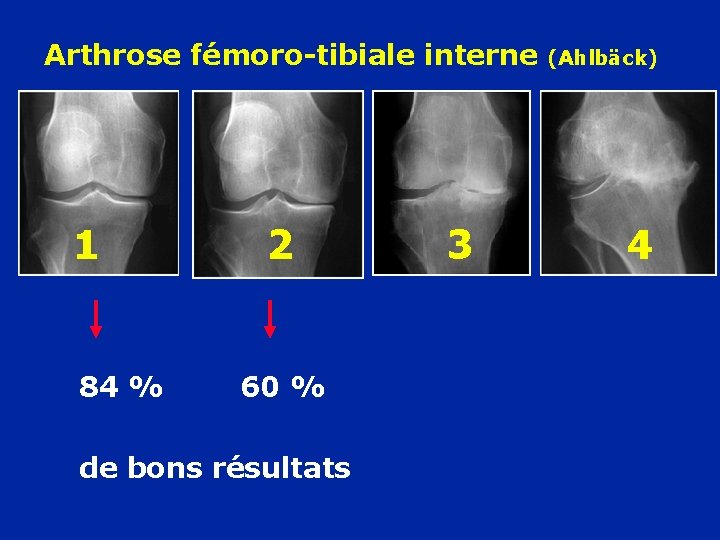 Arthrose fémoro-tibiale interne 1 84 % 2 60 % de bons résultats 3 (Ahlbäck)