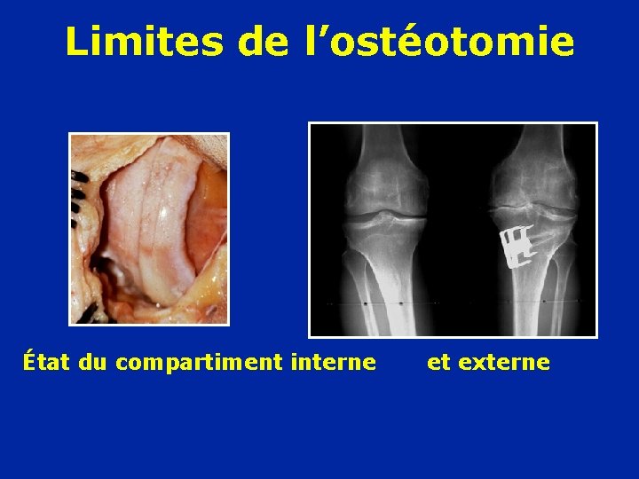 Limites de l’ostéotomie État du compartiment interne et externe 