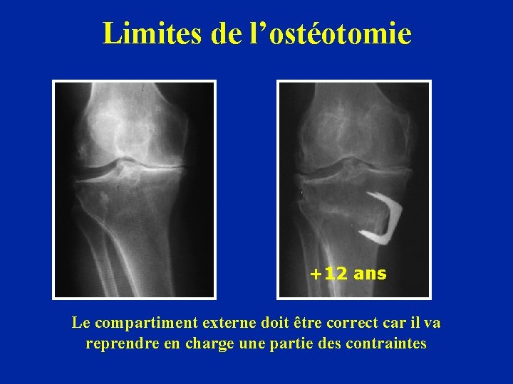 Limites de l’ostéotomie +12 ans Le compartiment externe doit être correct car il va