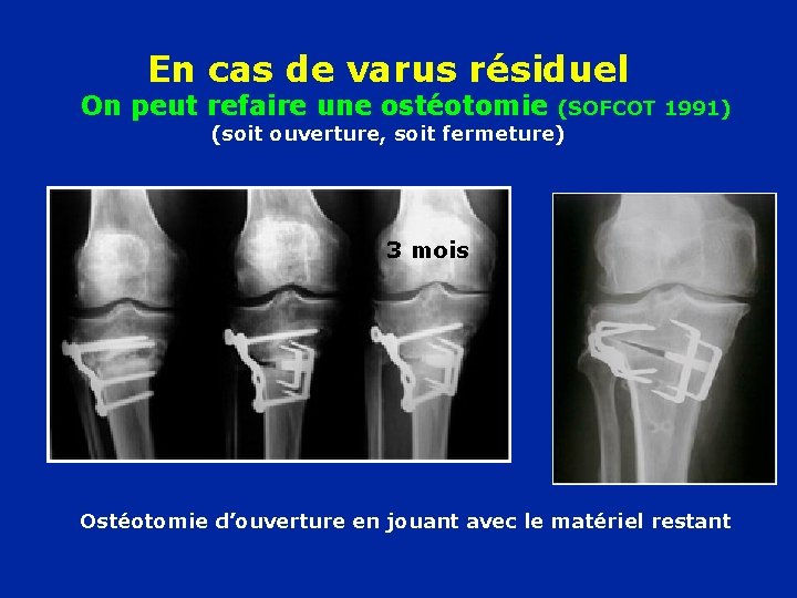 En cas de varus résiduel On peut refaire une ostéotomie (SOFCOT 1991) (soit ouverture,