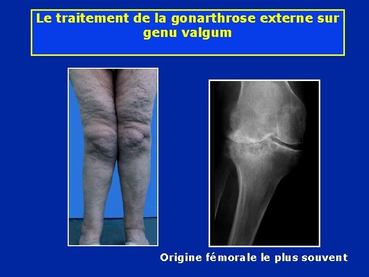 Le traitement de la gonarthrose externe sur genu valgum Origine fémorale le plus souvent