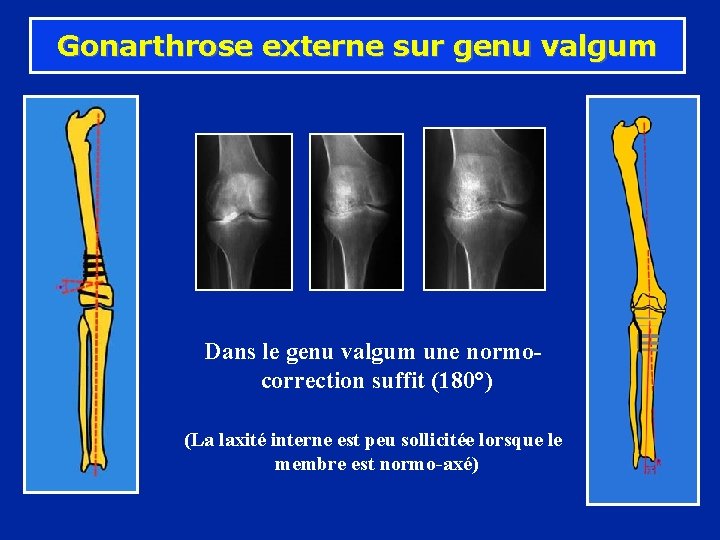 Gonarthrose externe sur genu valgum Dans le genu valgum une normocorrection suffit (180°) (La