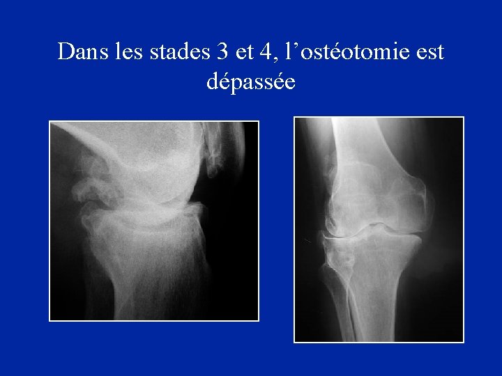 Dans les stades 3 et 4, l’ostéotomie est dépassée 