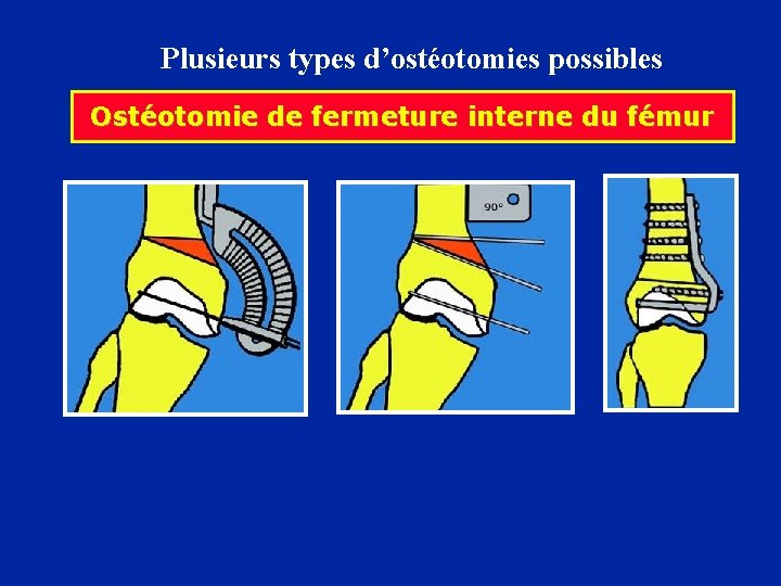 Plusieurs types d’ostéotomies possibles Ostéotomie de fermeture interne du fémur 