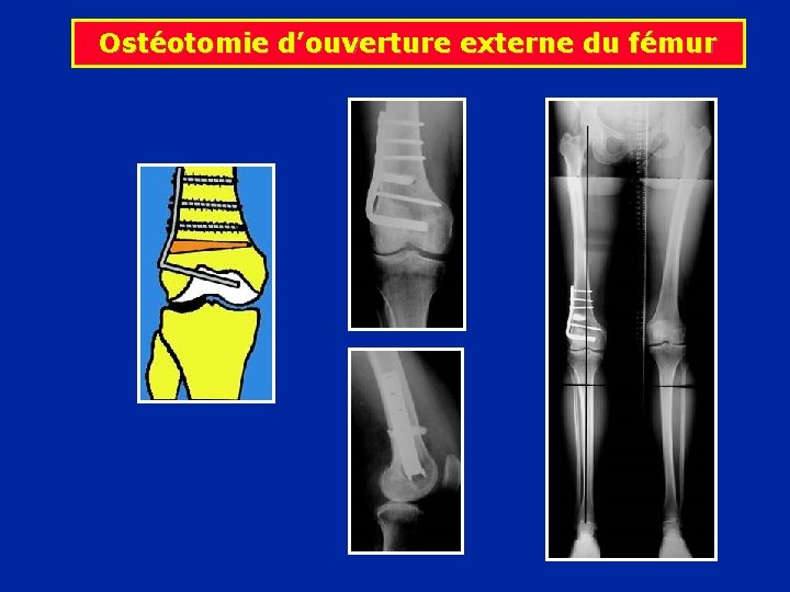 Ostéotomie d’ouverture externe du fémur 