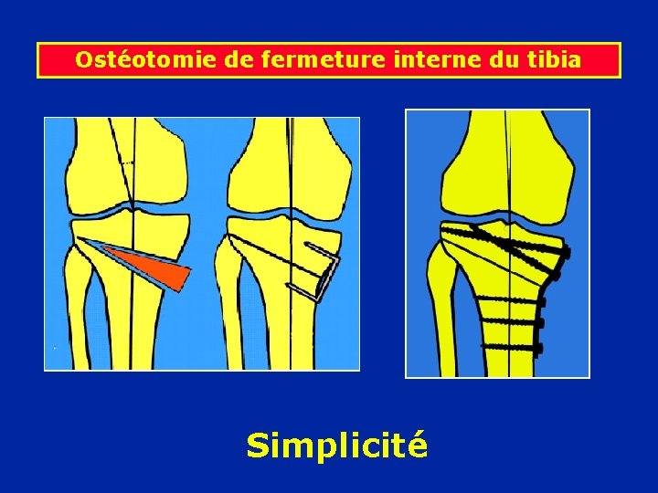 Ostéotomie de fermeture interne du tibia Simplicité 