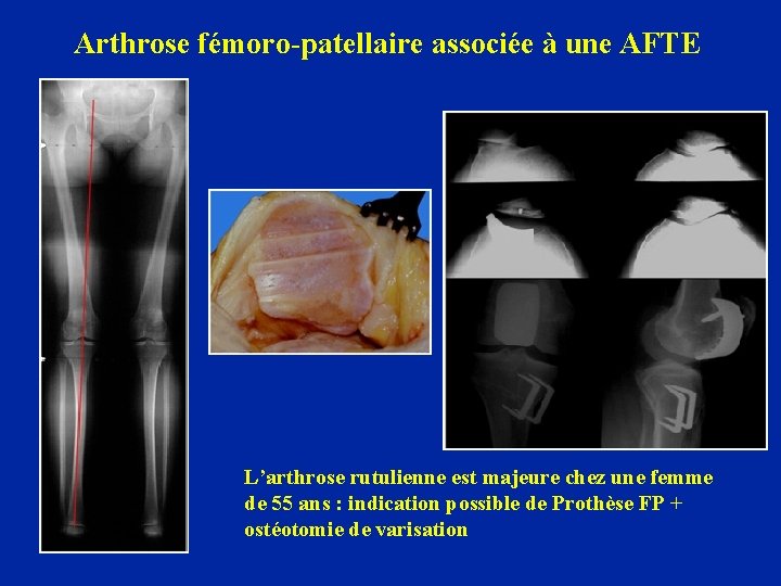 Arthrose fémoro-patellaire associée à une AFTE L’arthrose rutulienne est majeure chez une femme de