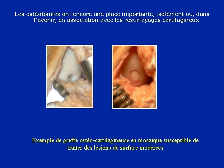 Les ostéotomies ont encore une place importante, isolément ou, dans l’avenir, en association avec