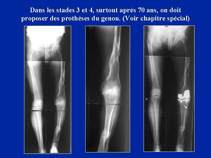 Dans les stades 3 et 4, surtout après 70 ans, on doit proposer des