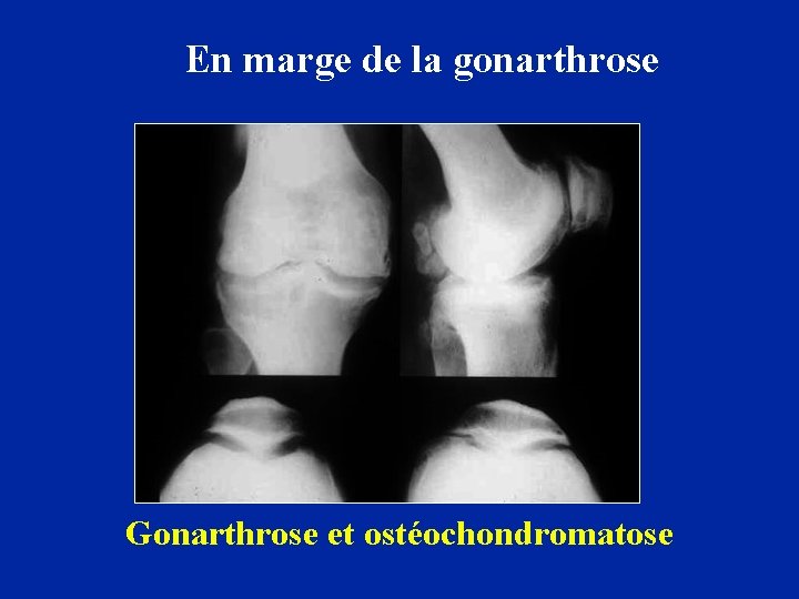 En marge de la gonarthrose Gonarthrose et ostéochondromatose 