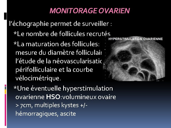 MONITORAGE OVARIEN l’échographie permet de surveiller : *Le nombre de follicules recrutés *La maturation