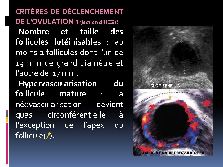 CRITÈRES DE DÉCLENCHEMENT DE L’OVULATION (injection d’HCG): -Nombre et taille des follicules lutéinisables :