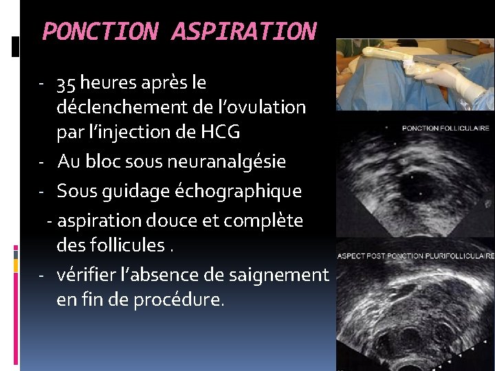 PONCTION ASPIRATION - 35 heures après le déclenchement de l’ovulation par l’injection de HCG