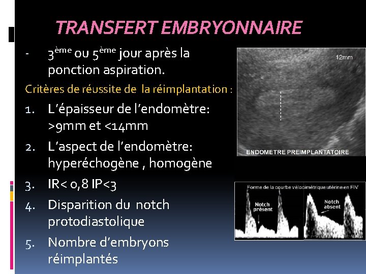 TRANSFERT EMBRYONNAIRE - 3ème ou 5ème jour après la ponction aspiration. Critères de réussite