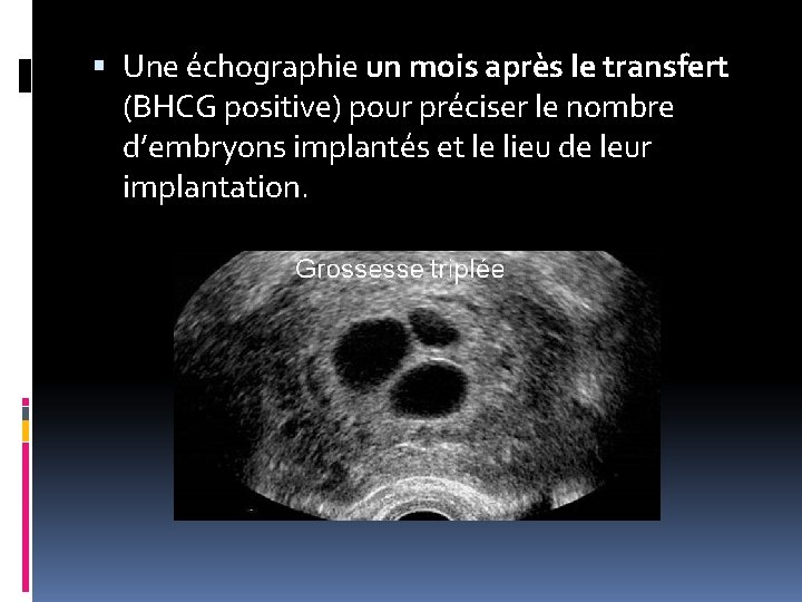  Une échographie un mois après le transfert (BHCG positive) pour préciser le nombre