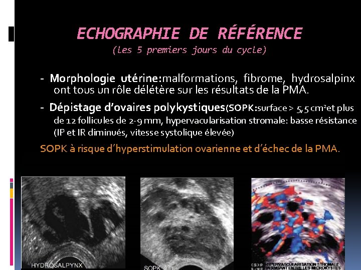 ECHOGRAPHIE DE RÉFÉRENCE (les 5 premiers jours du cycle) - Morphologie utérine: malformations, fibrome,