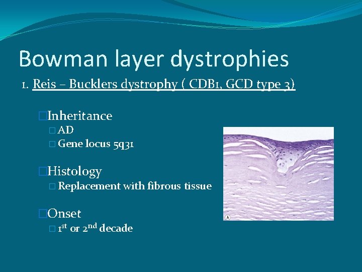 Bowman layer dystrophies 1. Reis – Bucklers dystrophy ( CDB 1, GCD type 3)