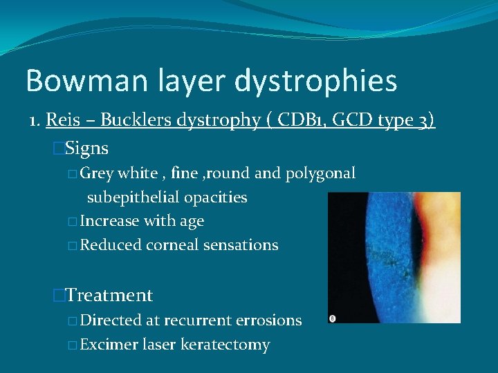 Bowman layer dystrophies 1. Reis – Bucklers dystrophy ( CDB 1, GCD type 3)
