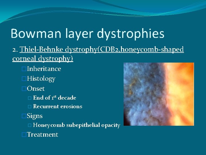 Bowman layer dystrophies 2. Thiel-Behnke dystrophy(CDB 2, honeycomb-shaped corneal dystrophy) �Inheritance �Histology �Onset �