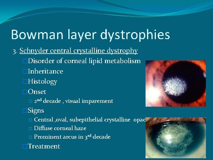 Bowman layer dystrophies 3. Schnyder central crystalline dystrophy �Disorder of corneal lipid metabolism �Inheritance