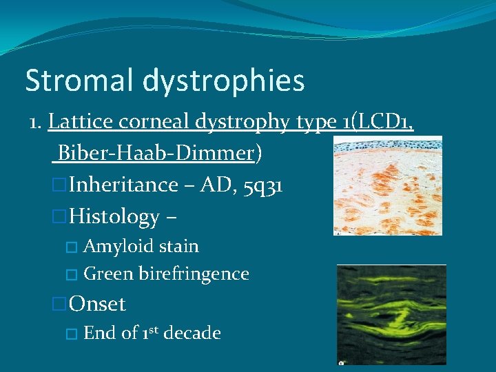 Stromal dystrophies 1. Lattice corneal dystrophy type 1(LCD 1, Biber-Haab-Dimmer) �Inheritance – AD, 5