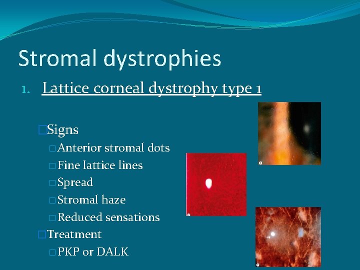 Stromal dystrophies 1. Lattice corneal dystrophy type 1 �Signs � Anterior stromal dots �