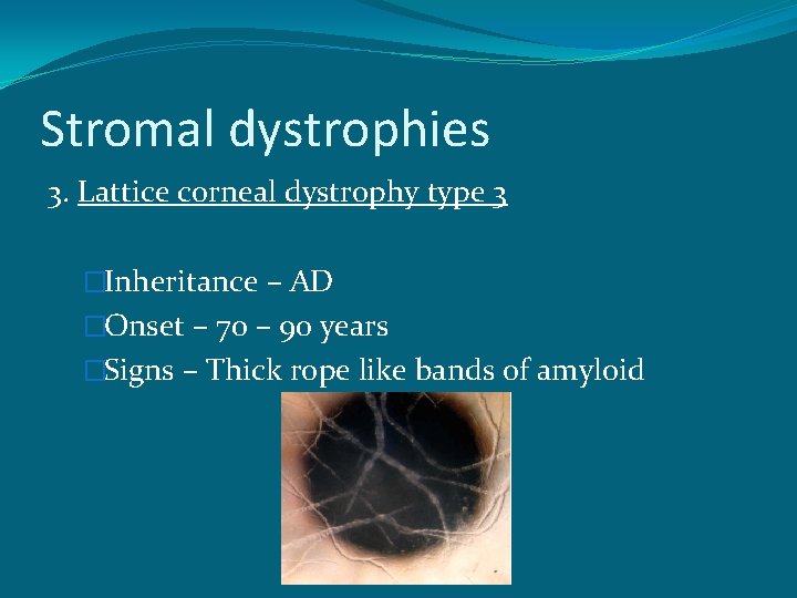 Stromal dystrophies 3. Lattice corneal dystrophy type 3 �Inheritance – AD �Onset – 70