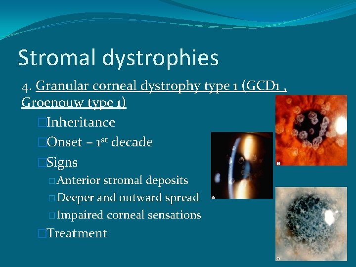 Stromal dystrophies 4. Granular corneal dystrophy type 1 (GCD 1 , Groenouw type 1)