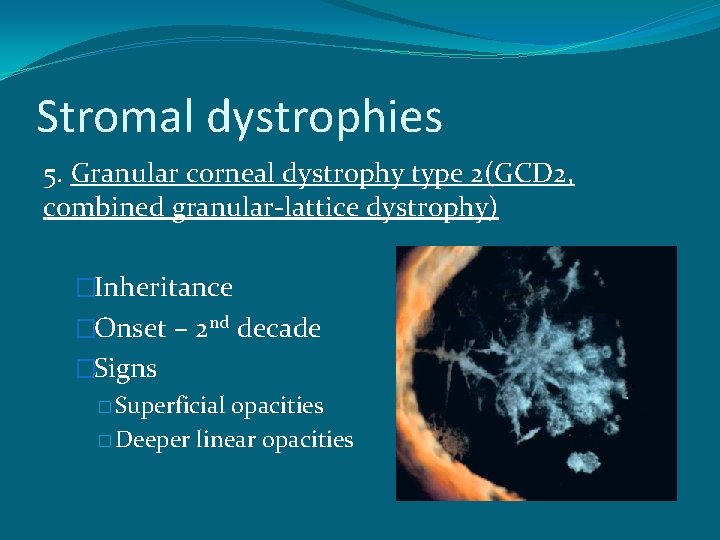 Stromal dystrophies 5. Granular corneal dystrophy type 2(GCD 2, combined granular-lattice dystrophy) �Inheritance �Onset