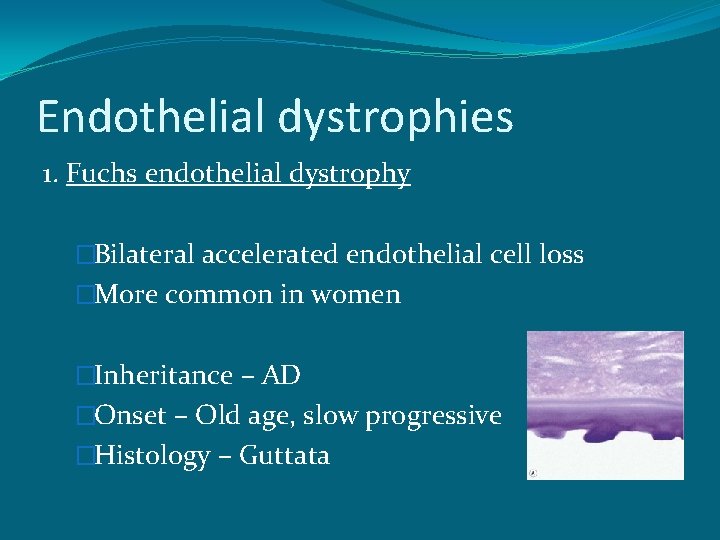 Endothelial dystrophies 1. Fuchs endothelial dystrophy �Bilateral accelerated endothelial cell loss �More common in