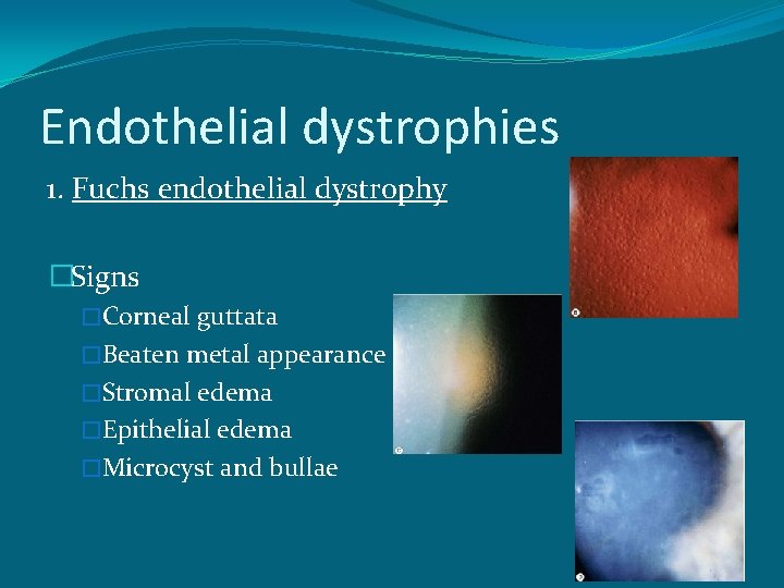 Endothelial dystrophies 1. Fuchs endothelial dystrophy �Signs �Corneal guttata �Beaten metal appearance �Stromal edema