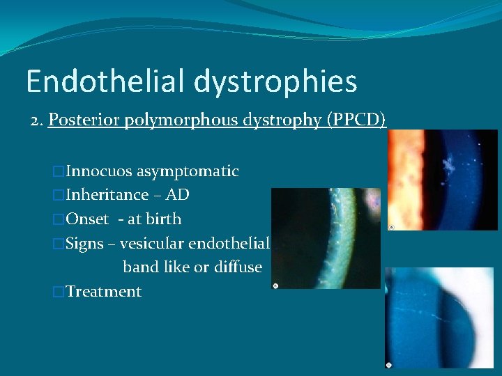 Endothelial dystrophies 2. Posterior polymorphous dystrophy (PPCD) �Innocuos asymptomatic �Inheritance – AD �Onset -