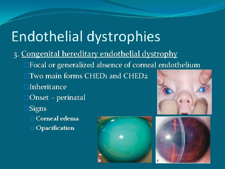 Endothelial dystrophies 3. Congenital hereditary endothelial dystrophy �Focal or generalized absence of corneal endothelium