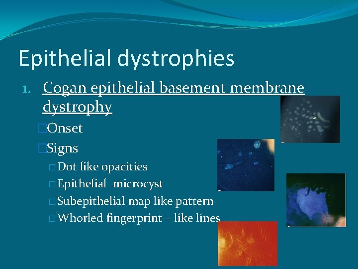 Epithelial dystrophies 1. Cogan epithelial basement membrane dystrophy �Onset �Signs � Dot like opacities