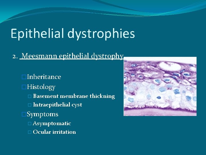 Epithelial dystrophies 2. Meesmann epithelial dystrophy �Inheritance �Histology � Basement membrane thickning � Intraepithelial