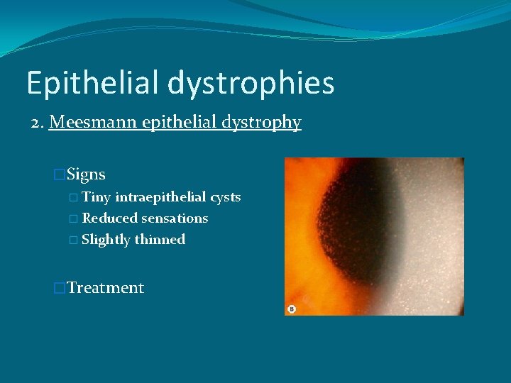 Epithelial dystrophies 2. Meesmann epithelial dystrophy �Signs � Tiny intraepithelial cysts � Reduced sensations