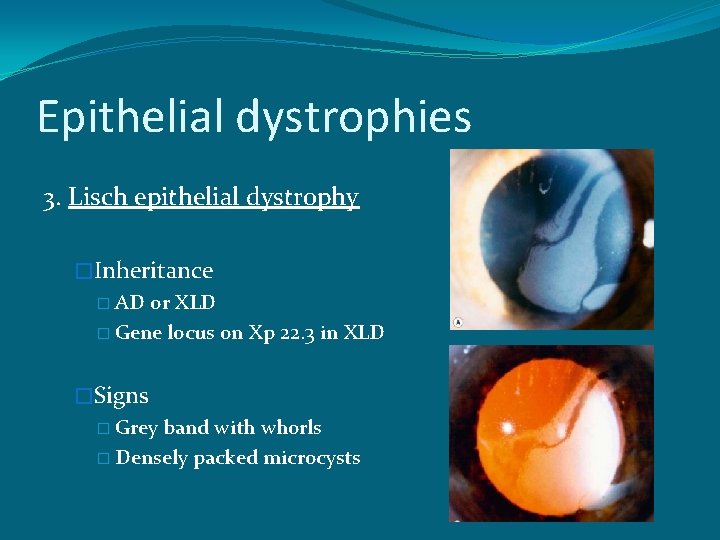 Epithelial dystrophies 3. Lisch epithelial dystrophy �Inheritance � AD or XLD � Gene locus