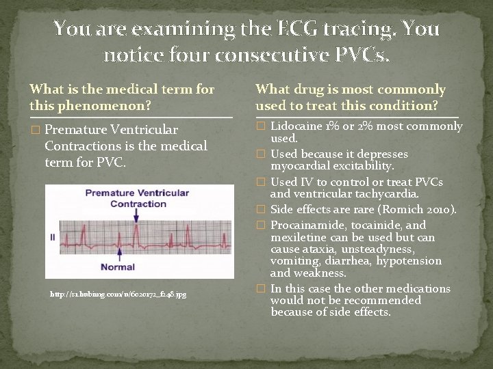 You are examining the ECG tracing. You notice four consecutive PVCs. What is the You are examining the ECG tracing. You notice four consecutive PVCs. What is the